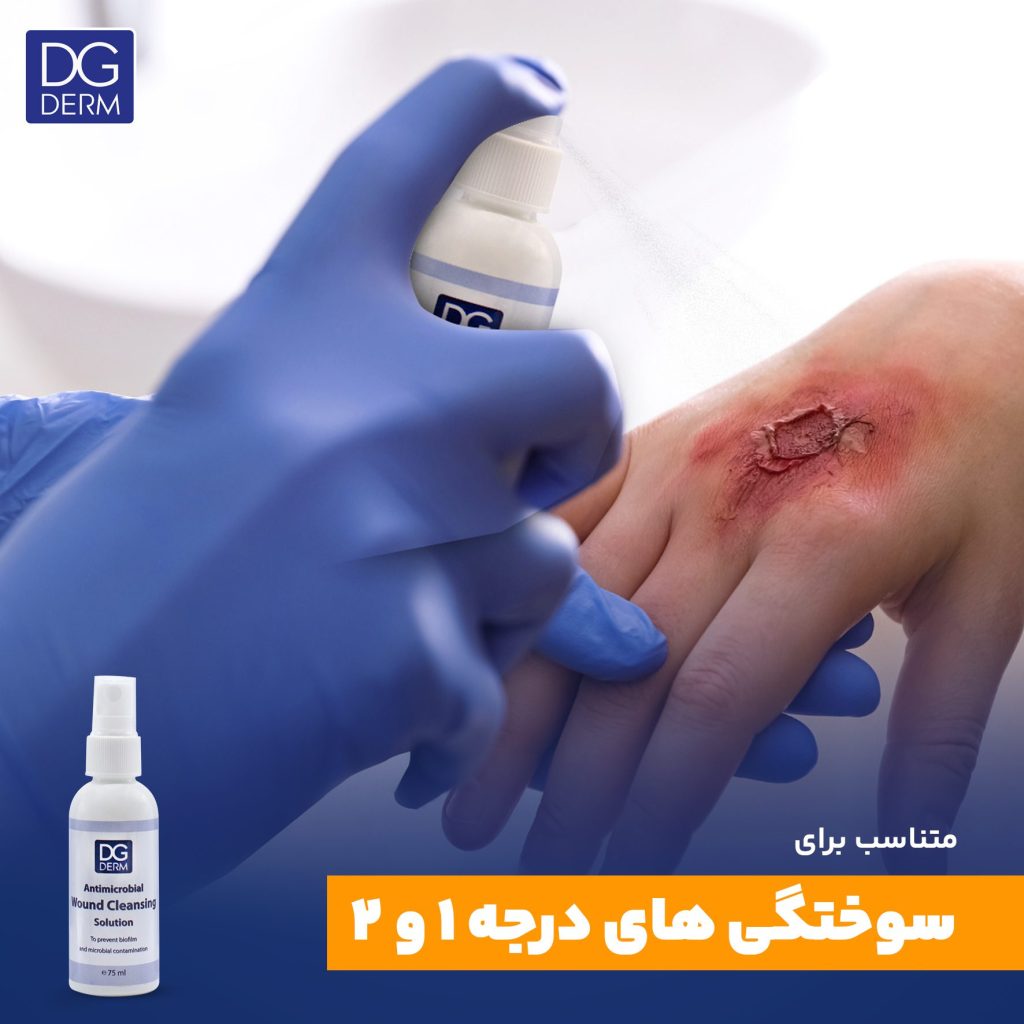 ضدعفونی کردن سوختگی